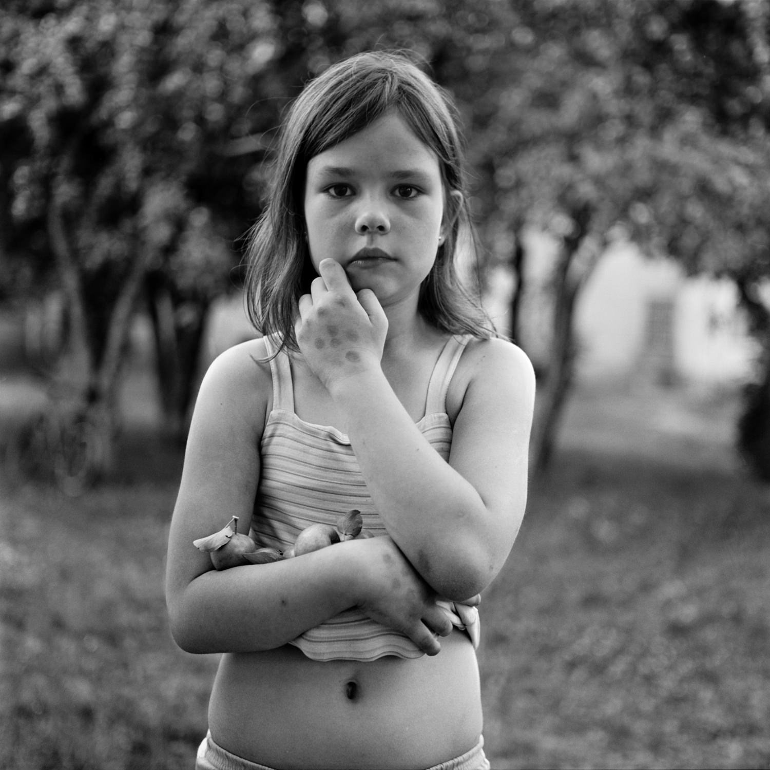 Exspressive black-white portrait of a child near trees, girl with dark spots on her hand holding green apples, film photo taken on medium format camera Bronica SQ-Ai